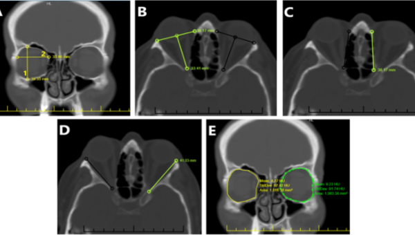 Machine learning algorithms and artificial neural networks for predicting schizophrenia using orbital parameters
